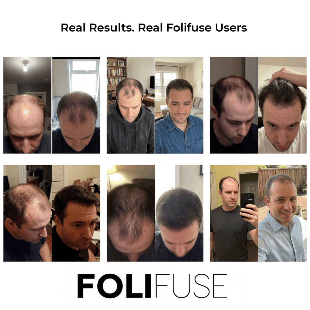 Folifuse Kit
