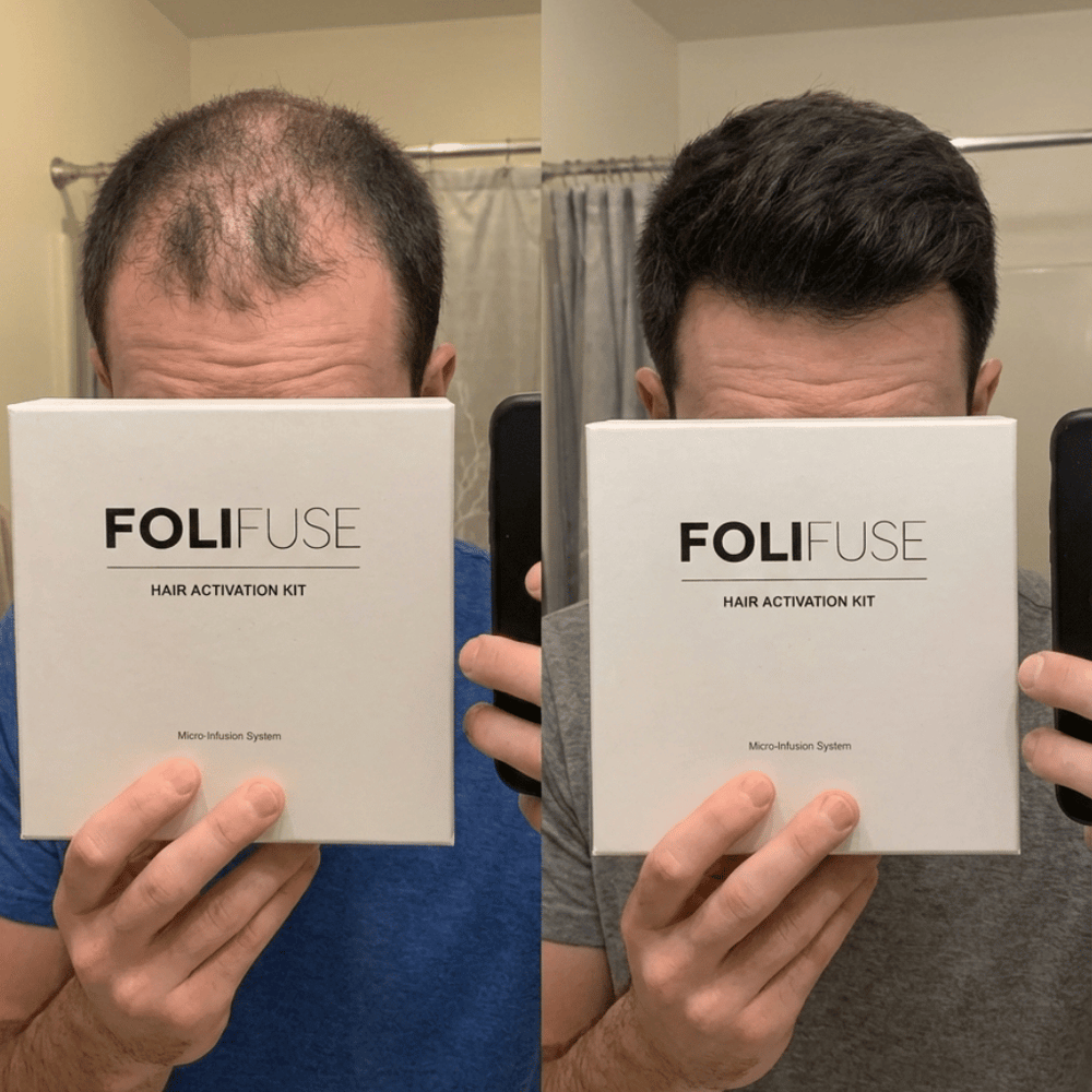Folifuse Kit