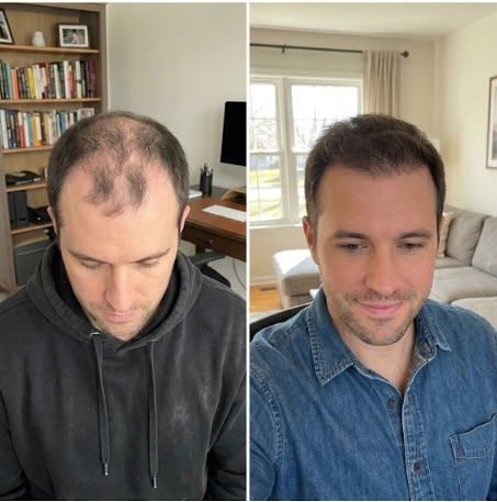 Marcus Reynolds before and after results