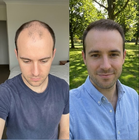 Daniel Park before and after results