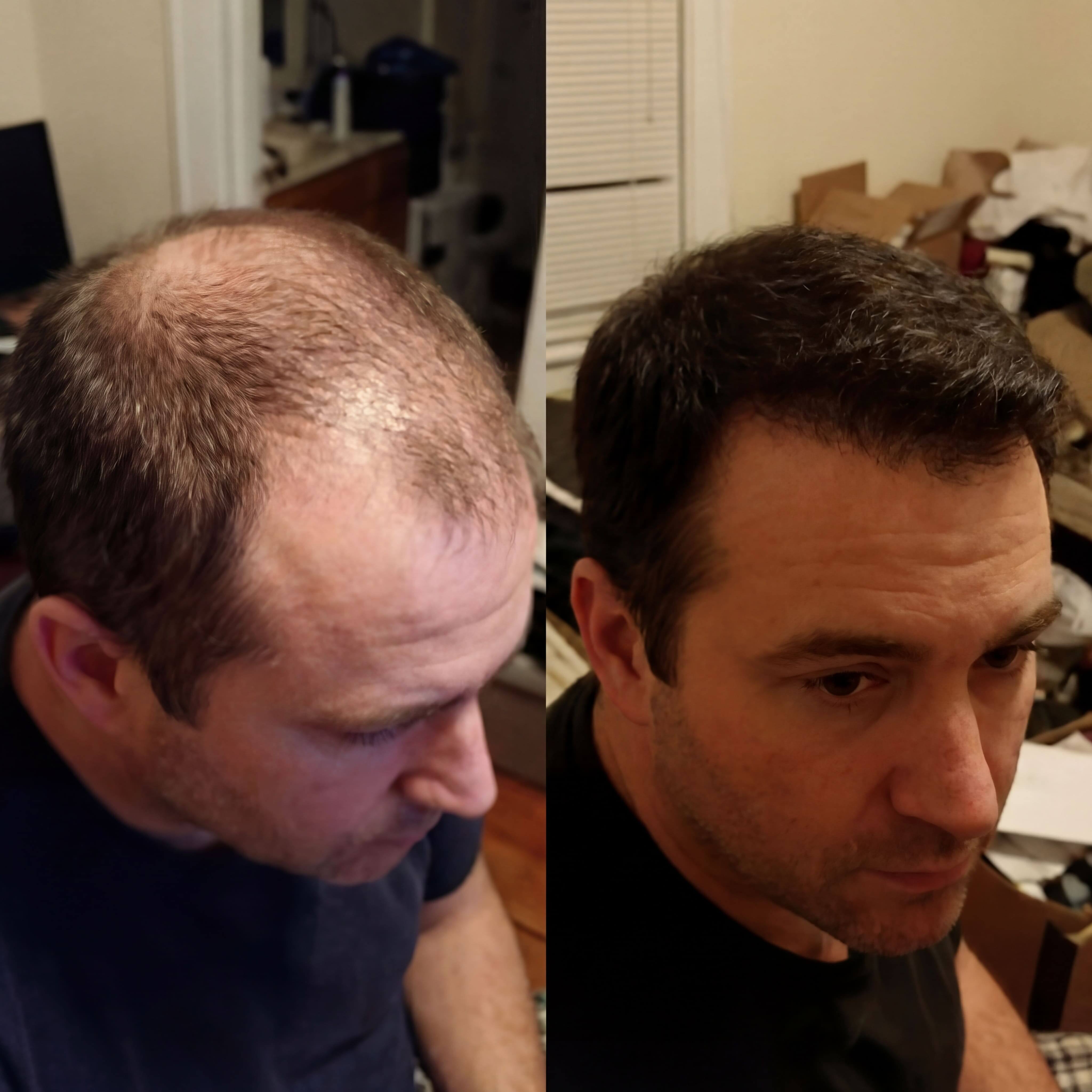 Robert Harrison before and after results