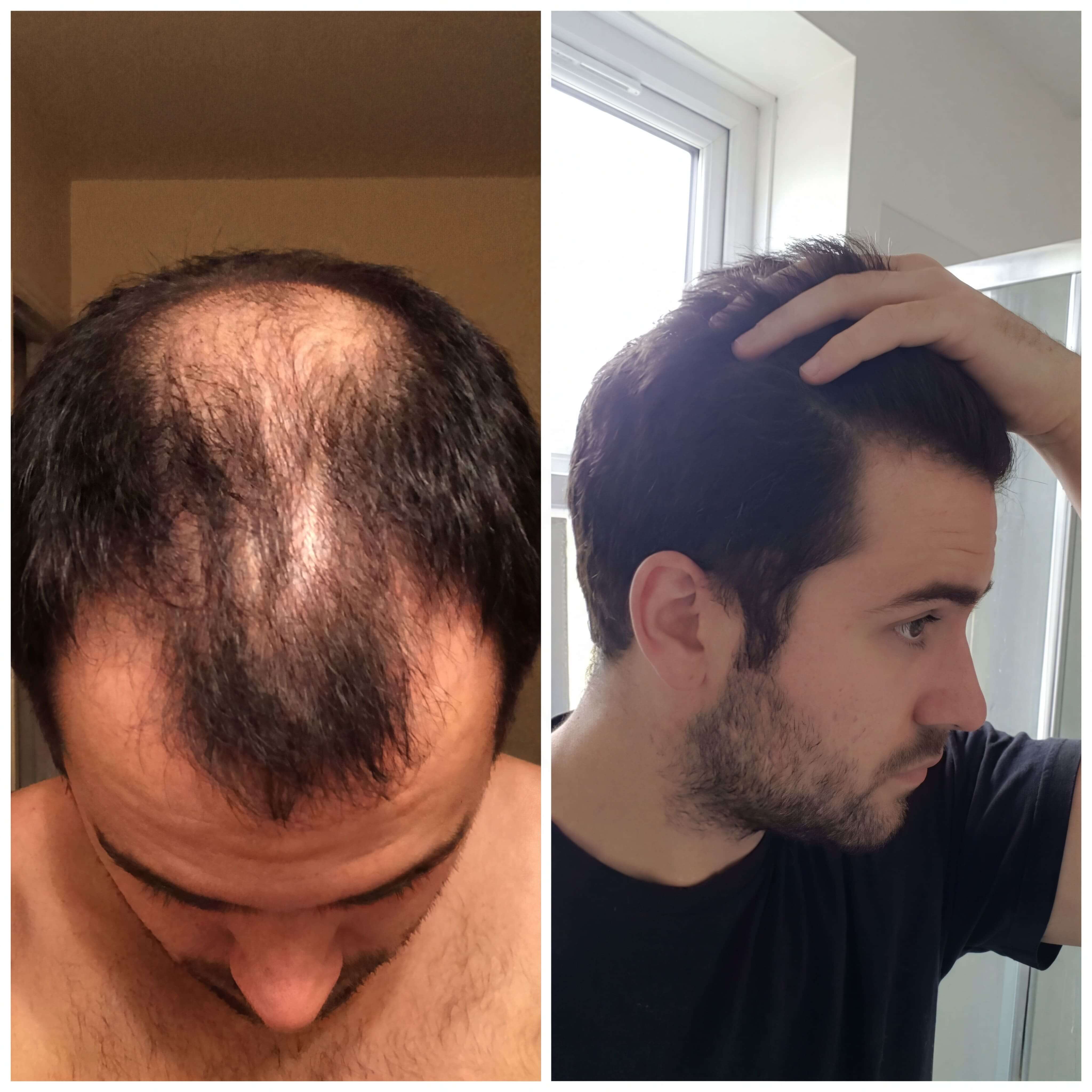 Kevin Martinez before and after results